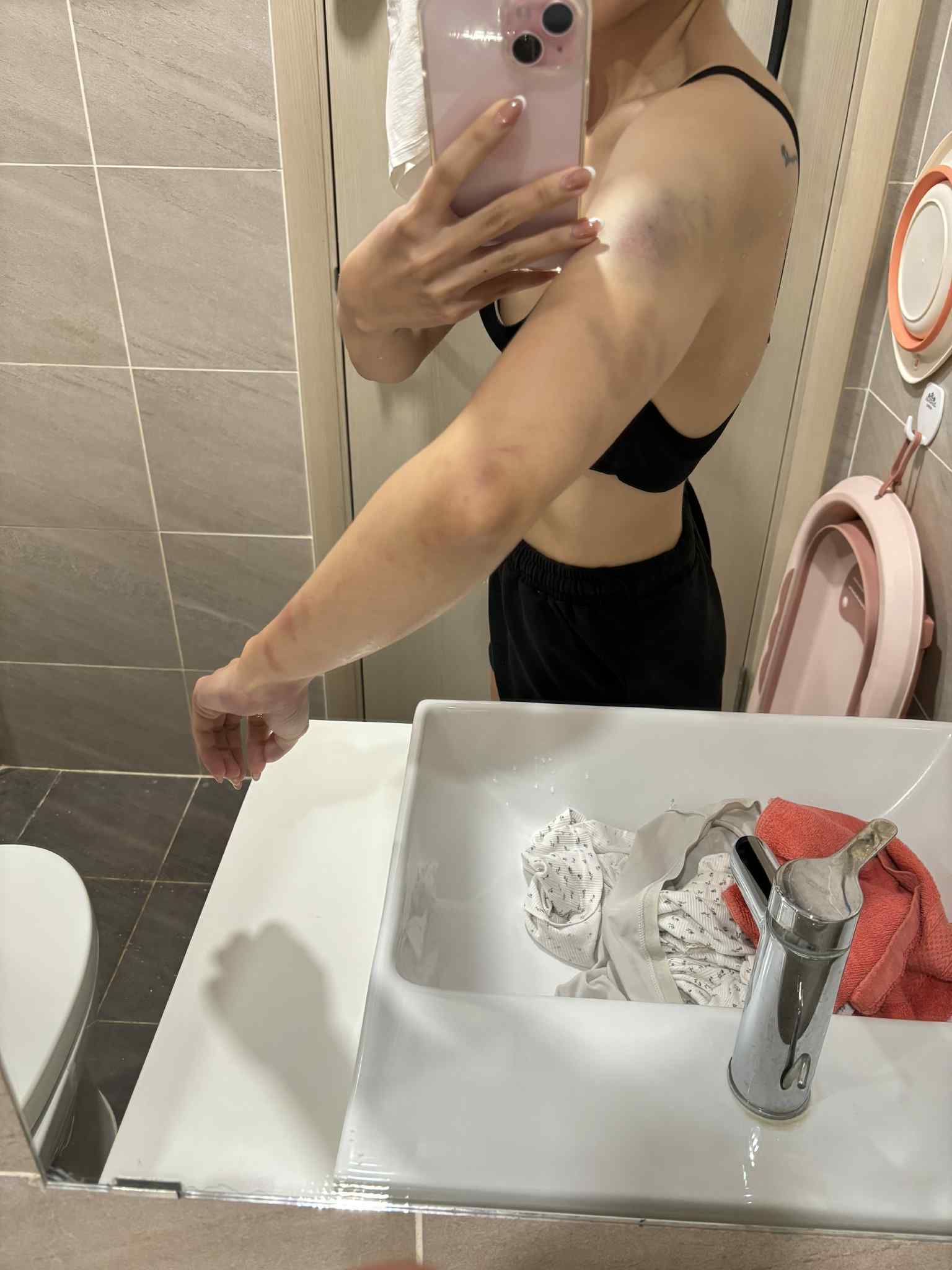 Chị Trang phải nhập viện với nhiều chấn thương khắp cơ thể (Ảnh: NVCC)