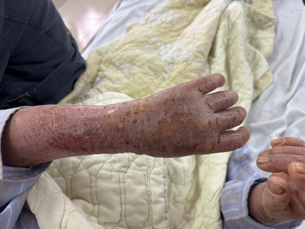 Bà L nhập viện trong tình trạng toàn thân nề đỏ, nứt nẻ, bong vảy, sốt và ngứa nhiều