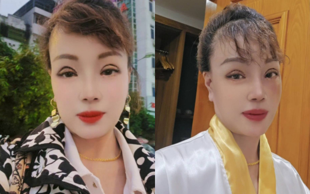 Dù chỉnh sửa bằng filter, nhưng những dấu hiệu sau phẫu thuật mí mắt vẫn không thể che hoàn toàn.