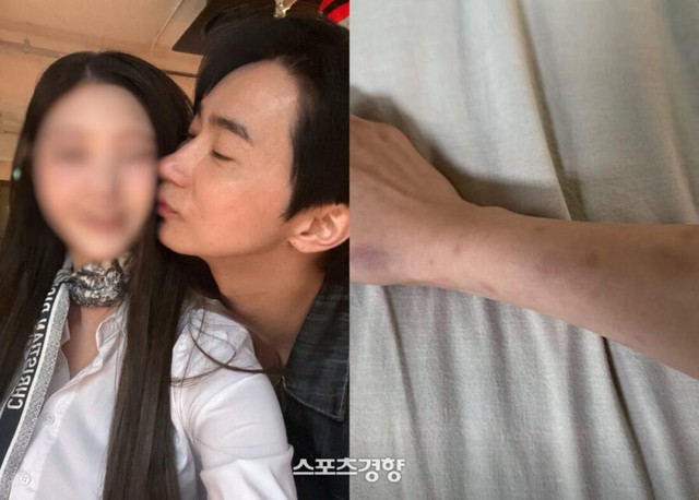 A cáo buộc Jeon Ho Jun đã đánh đập cô dẫn tới những vết bầm tím trên cơ thể. Ảnh: Naver
