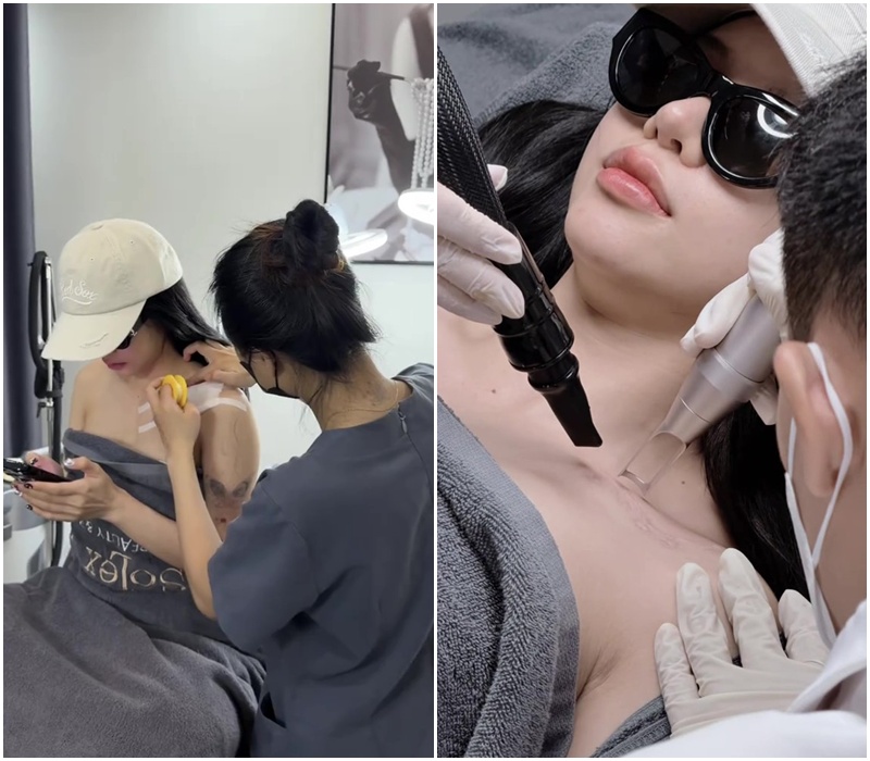 CiiN đã đi xoá xăm từ đầu tháng 12 (Ảnh: @masterlexxoaxam)