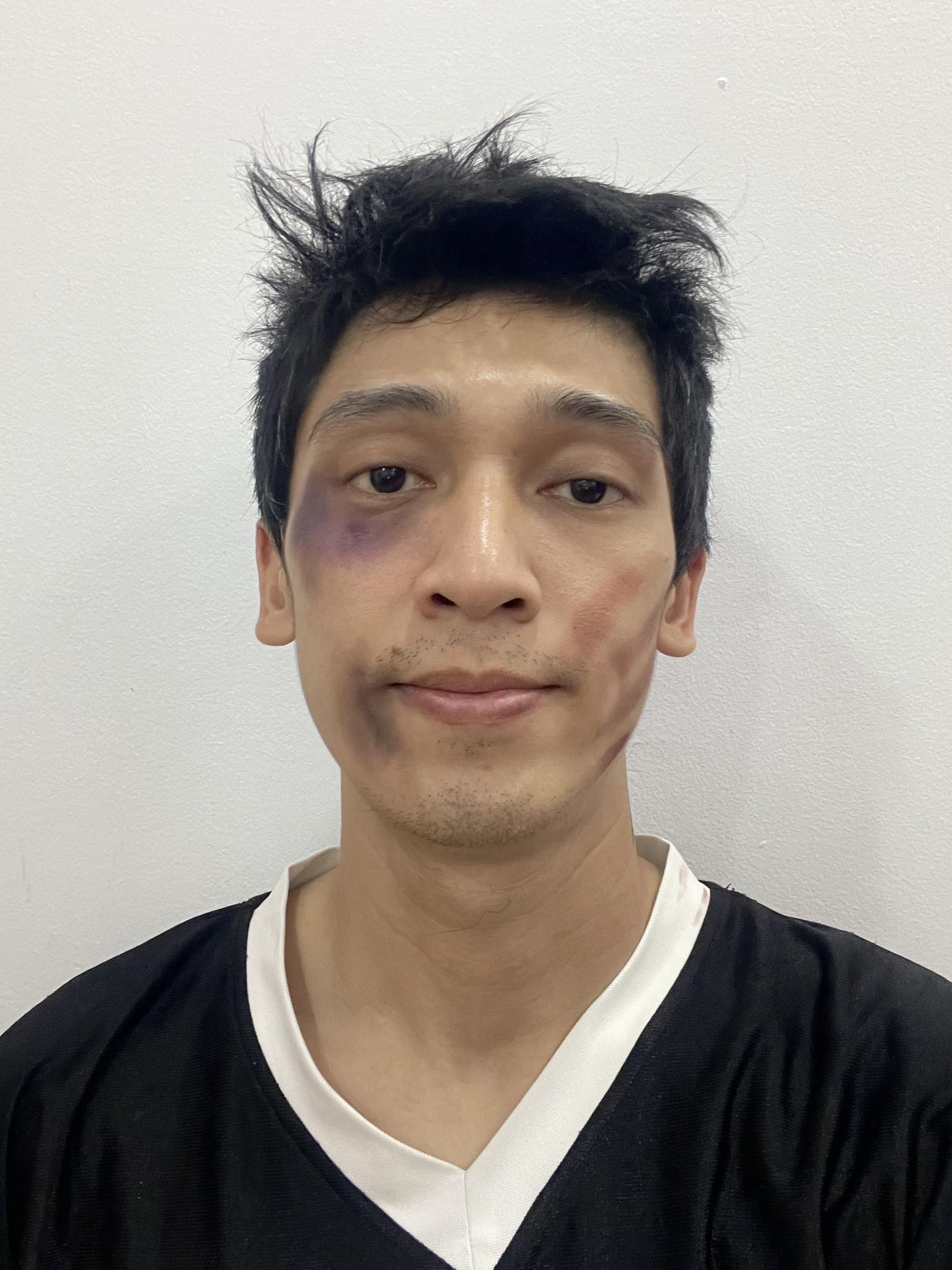 Tronie Ngô đăng ảnh mặt mũi bầm dập khiến dân tình xôn xao