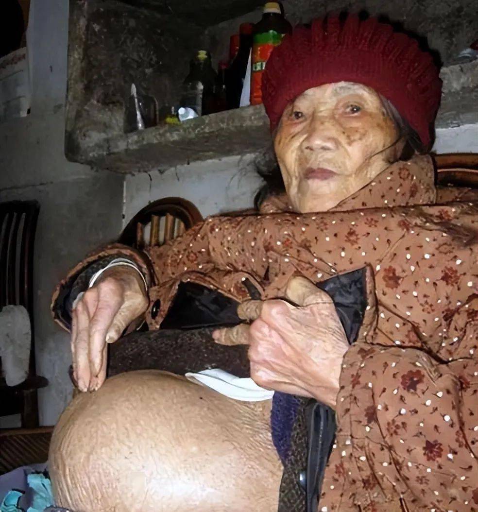 Cụ bà 91 tuổi ngã khi đi lấy nước, vào viện thì phát hiện “mang thai”: Bí mật về 