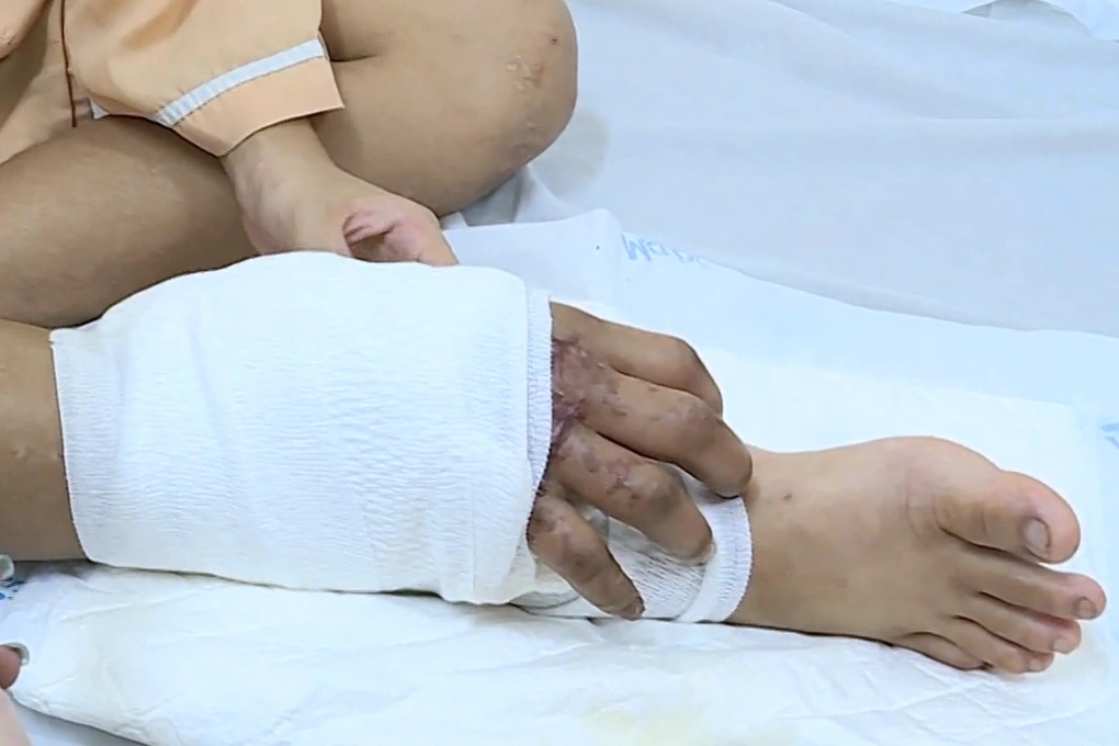 Hình ảnh bàn tay được nối vào chân trước đó từng khiến nhiều người sửng sốt