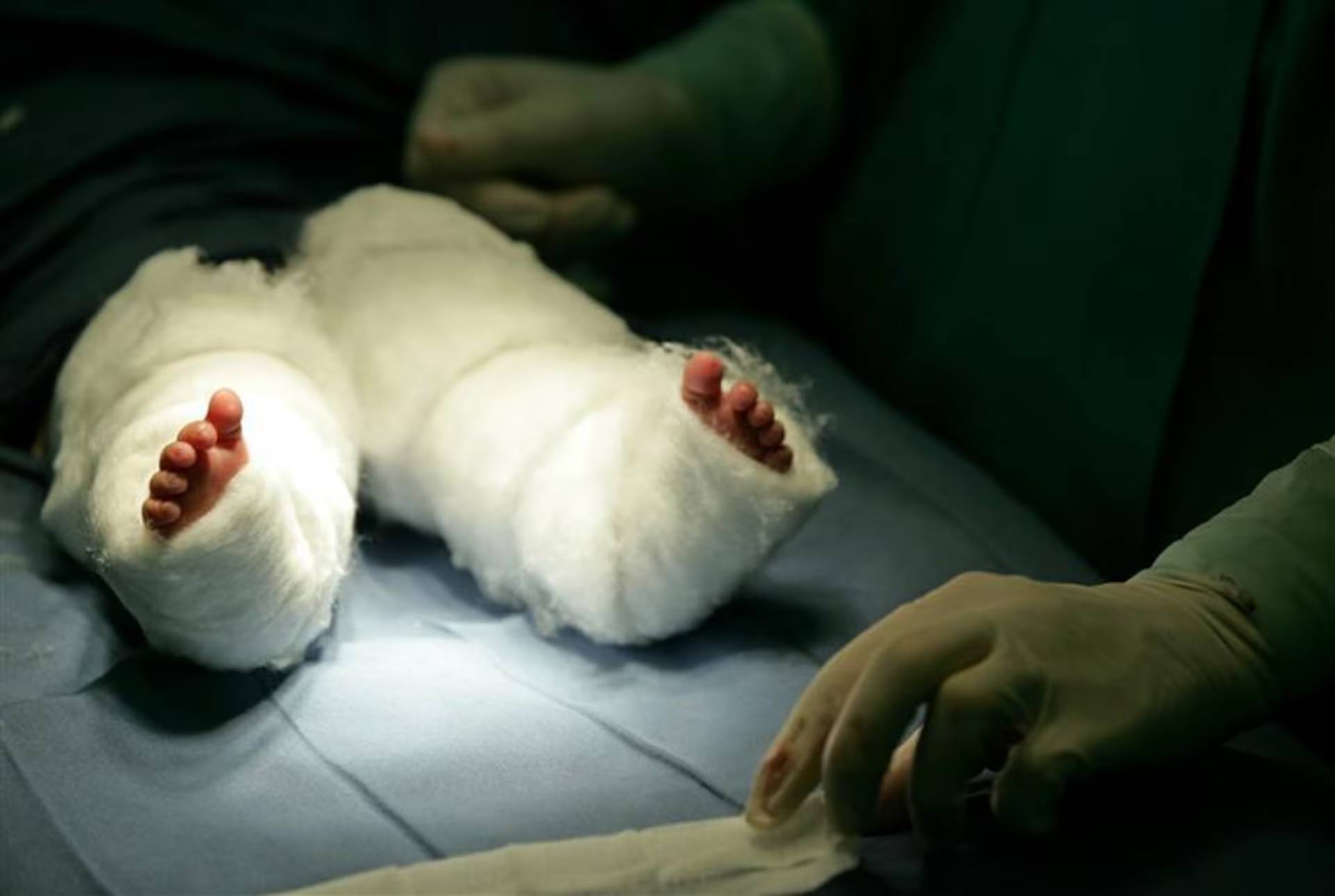 Nàng tiên cá ngoài đời thực: Bé gái chào đời với đôi chân dính liền và 15 năm sống năm phi thường như 