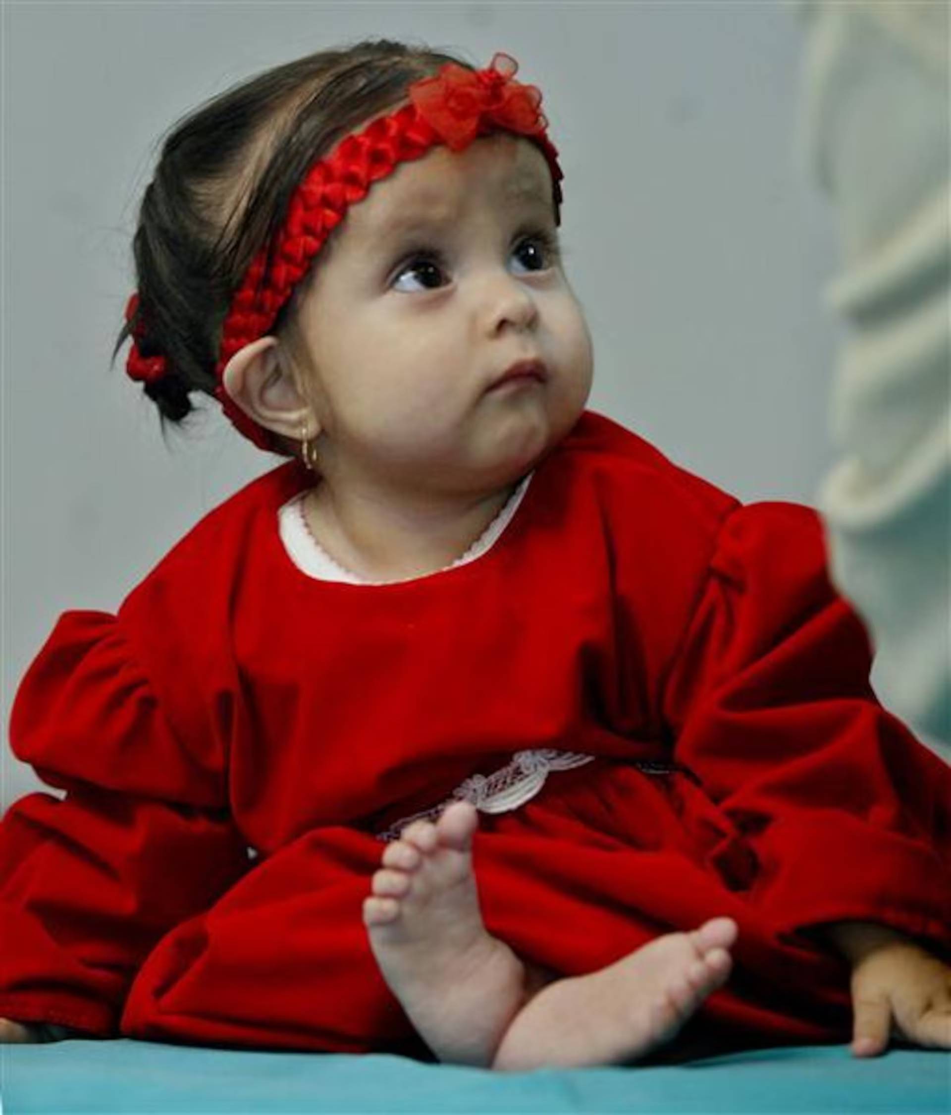 Nàng tiên cá ngoài đời thực: Bé gái chào đời với đôi chân dính liền và 15 năm sống năm phi thường như 