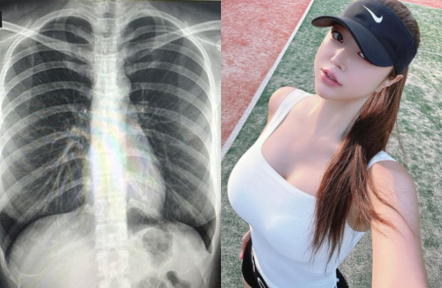 Choi Somi đăng ảnh chụp X-quang ngực để phủ nhận việc cô từng dao kéo nâng cấp vòng 1. Ảnh: Sina.