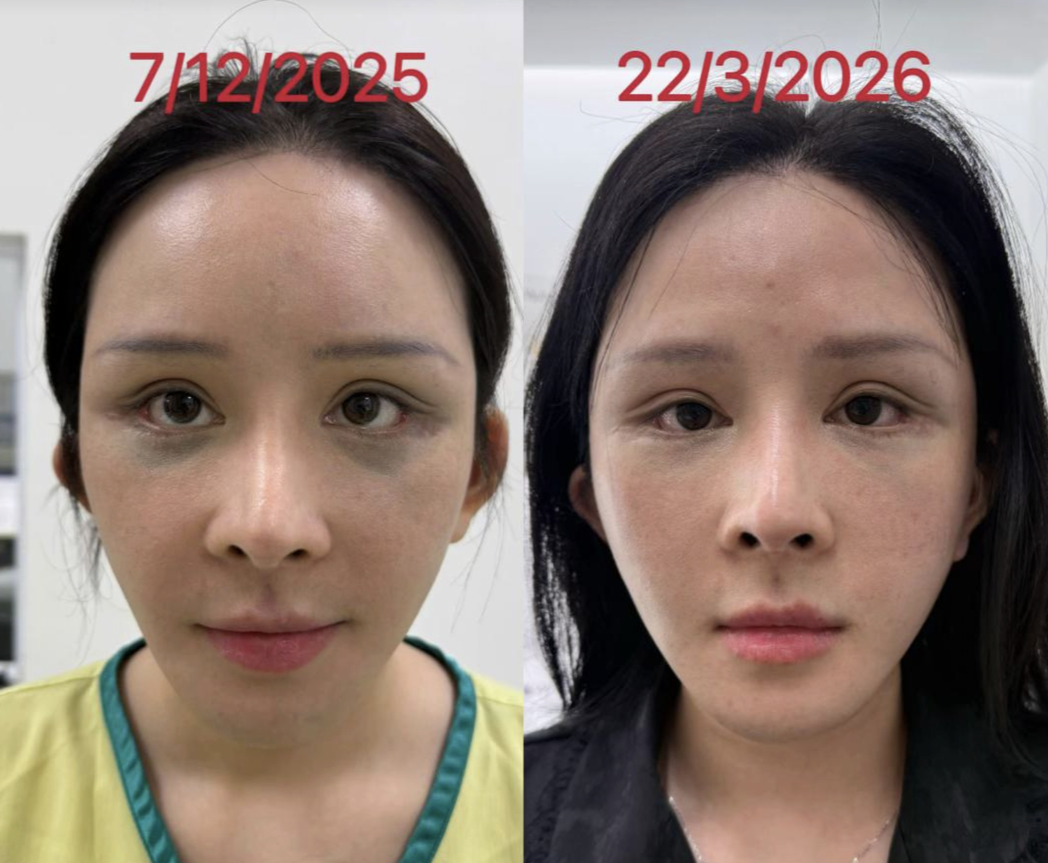 Phía bác sĩ cung cấp 2 hình ảnh được cho là thời gian đầu và hình mới nhất ngày 22/3 của Lucy, lúc này gương mặt của nữ bệnh nhân không có dấu hiệu lồi lõm như trên livestream (Ảnh bác sĩ Hoàng Vân). 