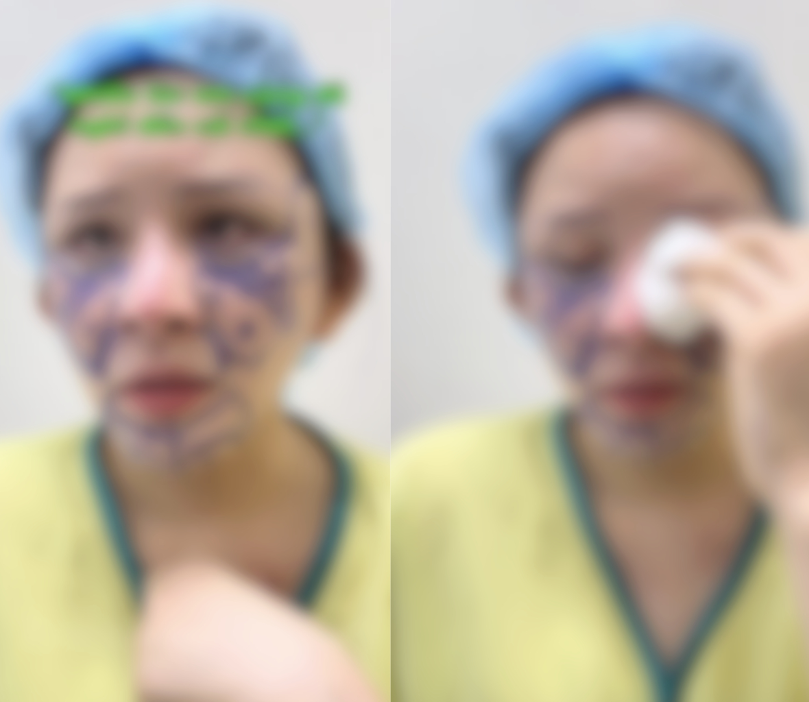 Nữ bệnh nhân khi tìm đến bác sĩ ngày đầu tiên, cô chia sẻ từng có nghĩ quẩn khi gương mặt thẩm mỹ bị lỗi khiến nhiều bác sĩ giỏi 