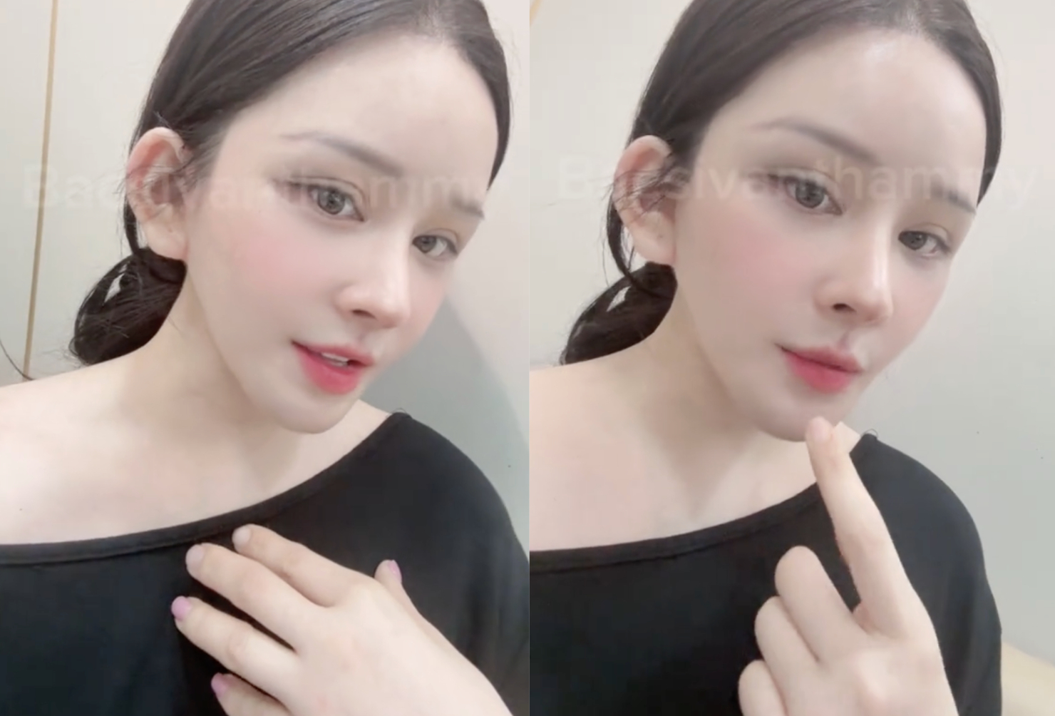 Thời điểm 3 tuần đầu tiên cô rất hài lòng với kết quả (Ảnh bác sĩ Hoàng Vân).