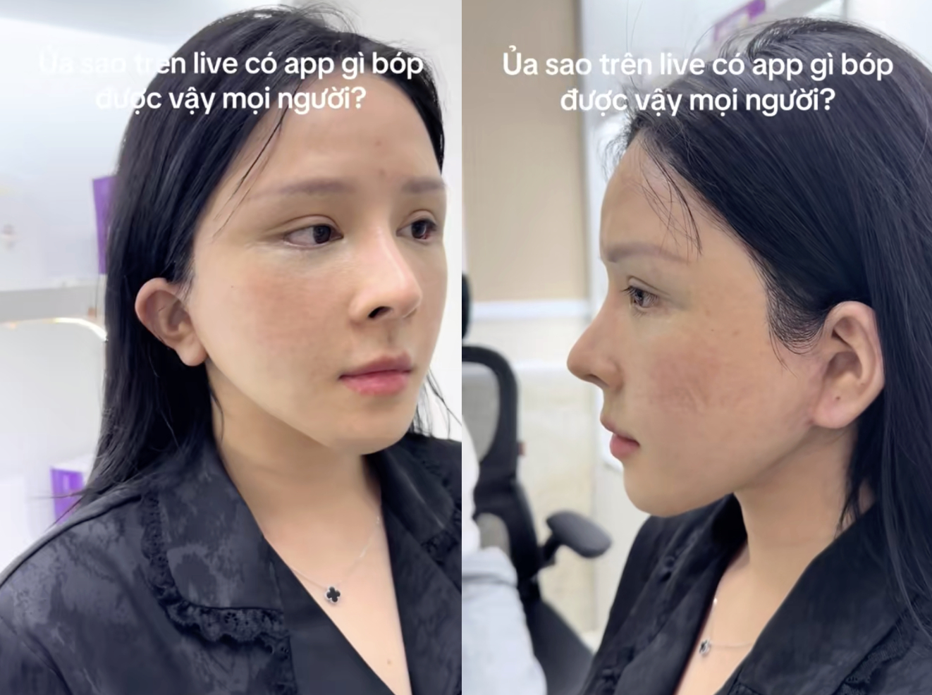 Bác sĩ khẳng định Lucy đã dùng chỉnh sửa bóp méo gương mặt trên điện thoại (Ảnh bác sĩ Hoàng Vân). 