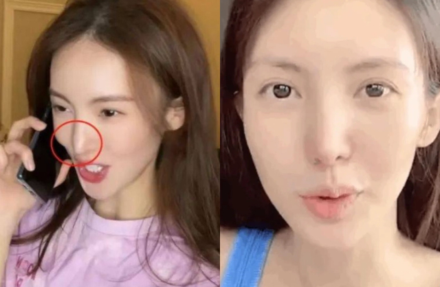 Hậu quả là vì can thiệp dao kéo quá nhiều, nữ diễn viên gánh chịu di chứng mũi nhọn hoắt thiếu tự, miệng lệch. Ảnh: Sina.