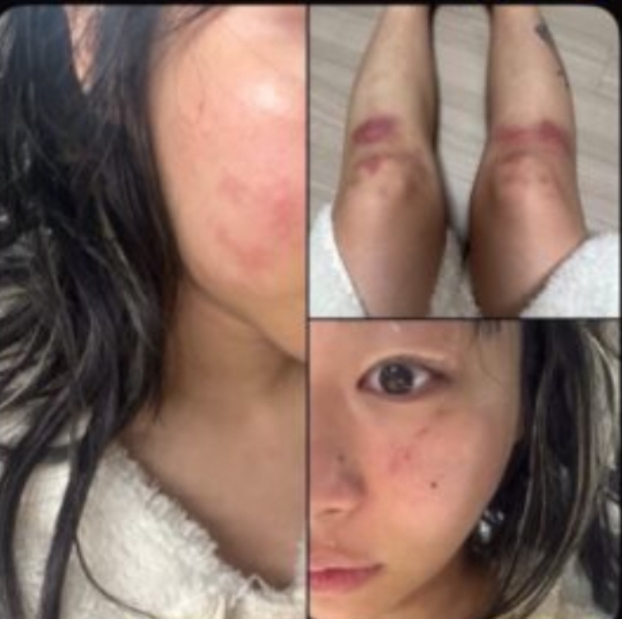Jvcki Wai tung ảnh bị bạn trai đánh bầm dập, gây ra thương tích trên khắp cơ thể cho cô. Ảnh: Naver