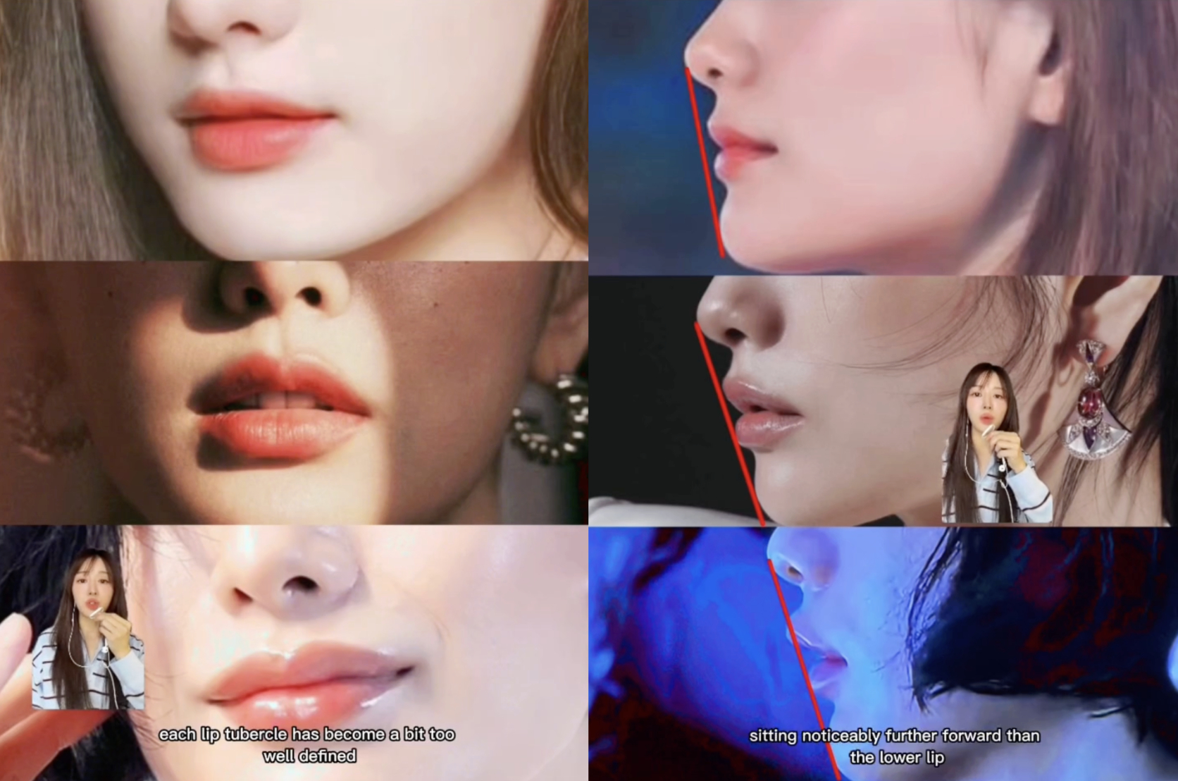 Nana tiêm quá dày phần môi trên làm lệch ra khỏi đường E-line vốn khá hoàn mỹ.  