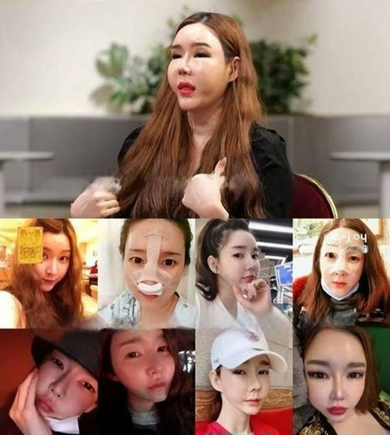 Dam Bi chi 2,5 tỷ để “dao kéo” gần như toàn bộ gương mặt và cơ thể. Không khó để nhận ra khuôn mặt cô đã thay đổi chóng mặt qua năm tháng. Ảnh: Naver