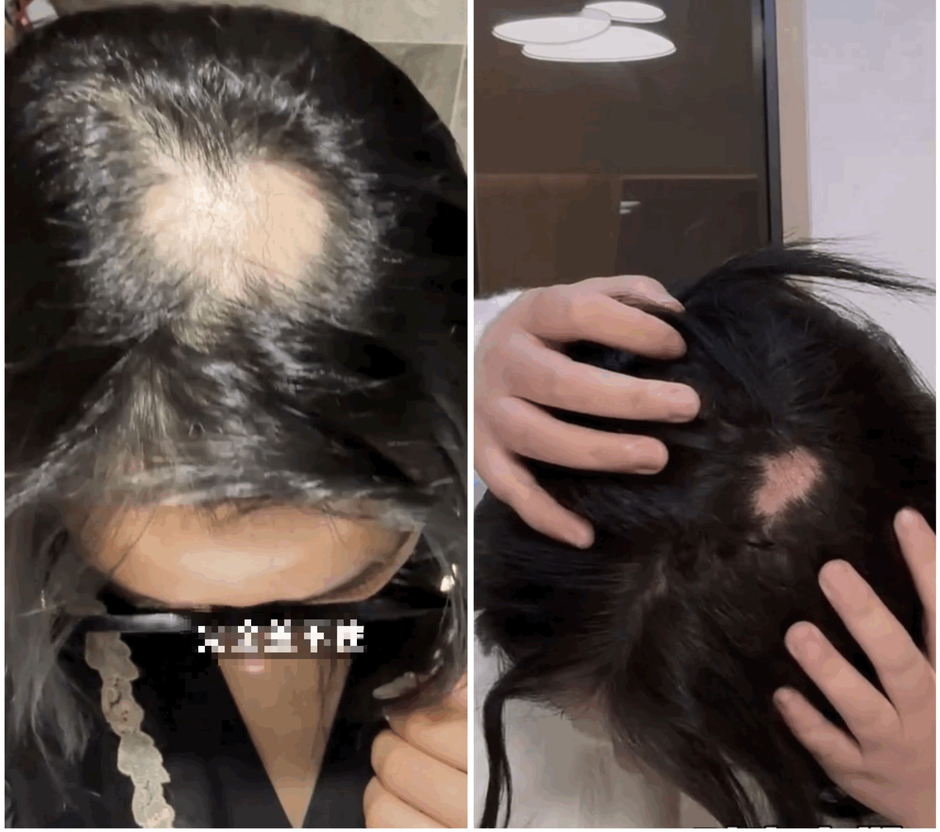 Một beauty blogger sở hữu hơn 1 triệu người theo dõi trên Douyinbị hói đầu sau khi tiêm chất làm đầy. 