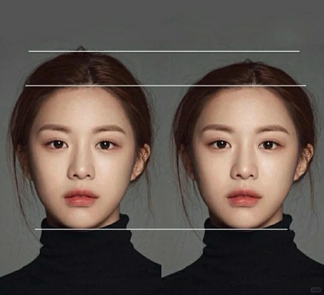 Các thẩm mỹ viện tung ra loạt hình ảnh trước - sau với sự khác biệt rõ rệt, kèm theo những lời khẳng định chắc nịch như “giải pháp cứu cánh cho khuôn mặt to” hay “nâng đỉnh đầu một lần hiệu quả hơn nhiều lần nâng mặt”. Thậm chí, có nơi còn chỉnh sửa, cắt ghép hình ảnh của người nổi tiếng để minh họa cho “chuẩn hộp sọ cao”, tạo cảm giác đây là xu hướng được các gương mặt đình đám theo đuổi. 