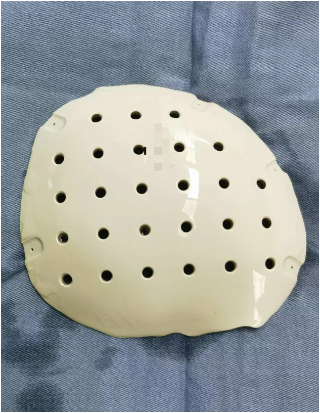 Hoặc PEEK - một dạng vật liệu cấy ghép in 3D.