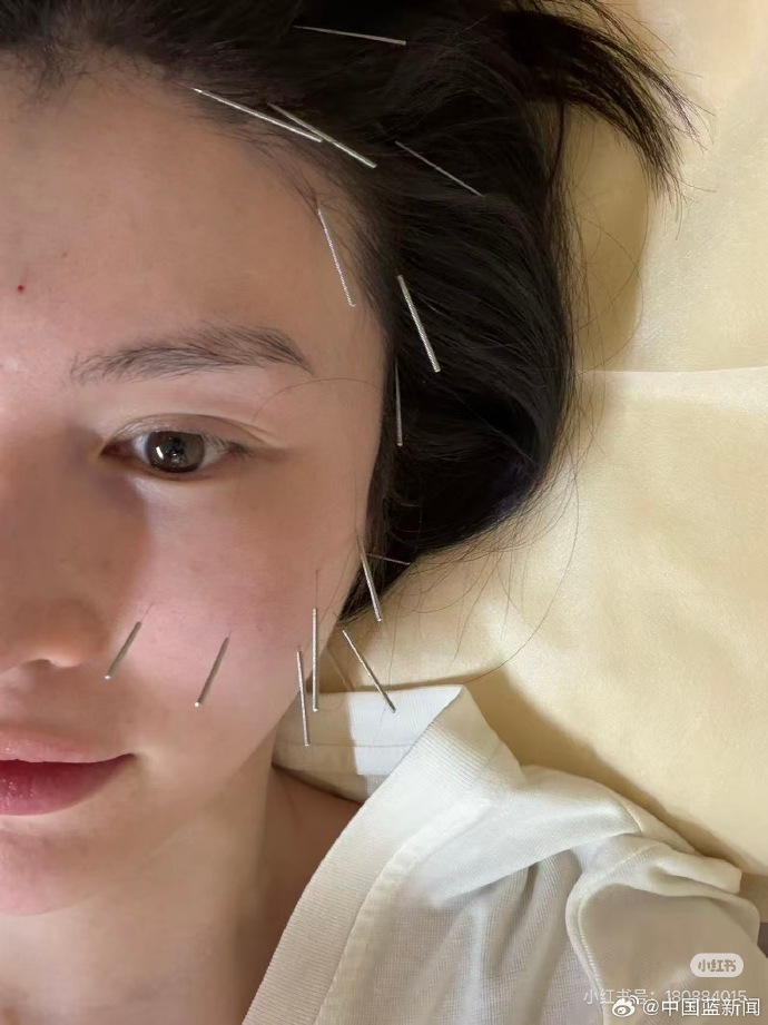 Cô lựa chọn châm cứu nâng cơ để chống lão hoá sau sinh.