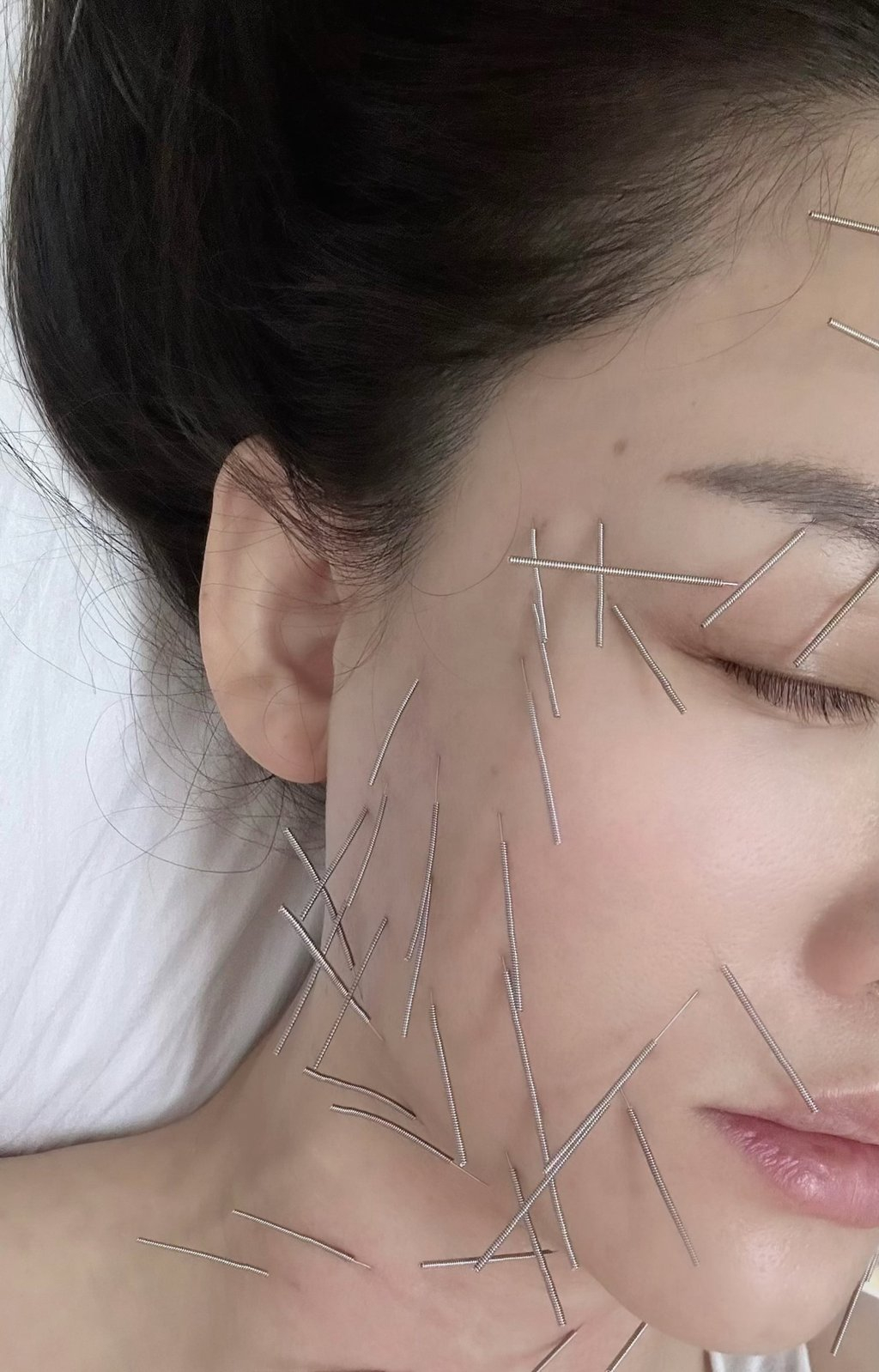 Nữ diễn viên Trần Kiều Ân cũng từng gây bất ngờ khi đăng ảnh châm cứu.