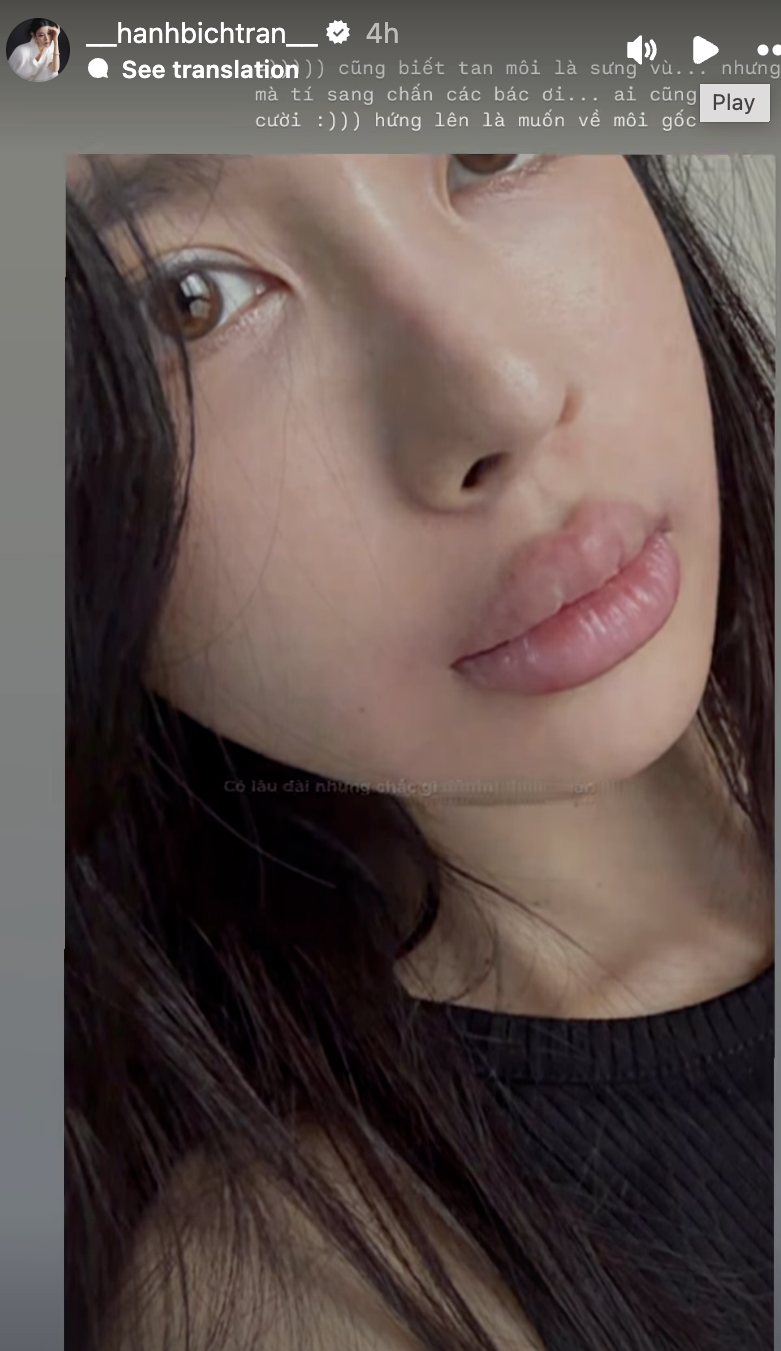 Bích Hạnh không ngại công khai ảnh mặt mộc, môi sưng vù khi tiêm tan môi