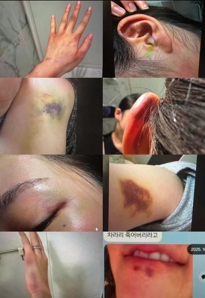 Chị dâu Jisoo đăng ảnh thương tích toàn thân khiến công chúng lạnh gáy. Ảnh: X