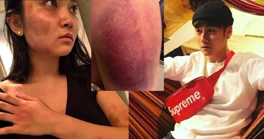 Nam diễn viên đánh đập bạn gái người Nhật dã man, thương tích khắp người. Ảnh: Sina.