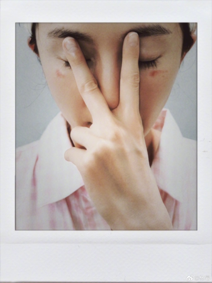 Hình ảnh Dương Mịch bị bỏng do sử dụng mặt nạ mắt xông hơi leo thẳng hot search. (Ảnh: Weibo)