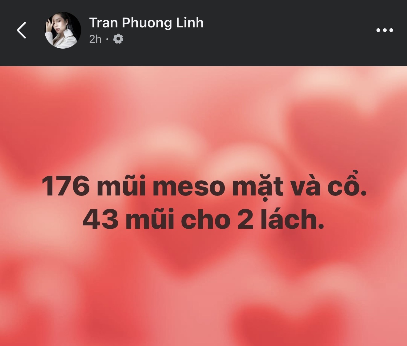 Nữ ca sĩ Việt 42 tuổi tự so mình với Song Hye Kyo, công khai 176 mũi tiêm trên mặt và 43 mũi ở vùng 