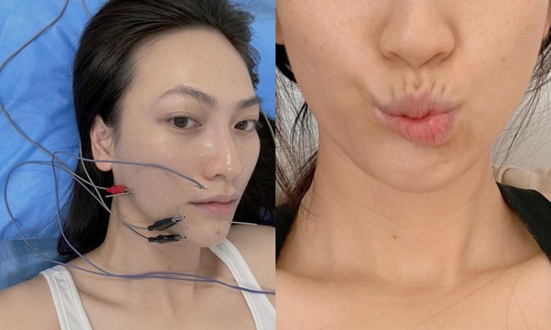   Cô đã trải qua việc mổ tuyến giáp và còn bị di chứng lệch méo khuôn môi. Ảnh: FBNV  