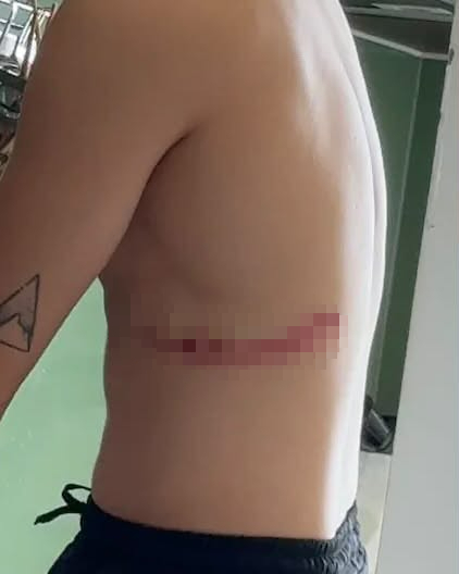 Nam ca sĩ Việt ngã nhào trên sân khấu, nhập viện khẩn vì gãy xương sườn
