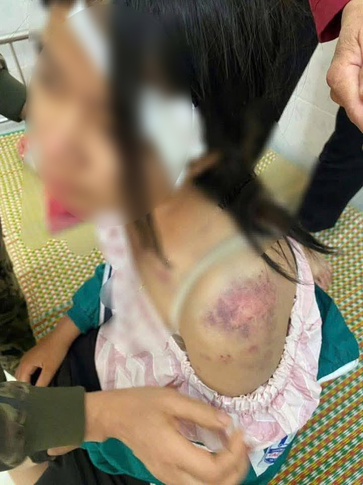 Cháu P.A. bị người thân đánh đến bầm tím cơ thể, tỷ lệ tổn thương cơ thể là 5%.