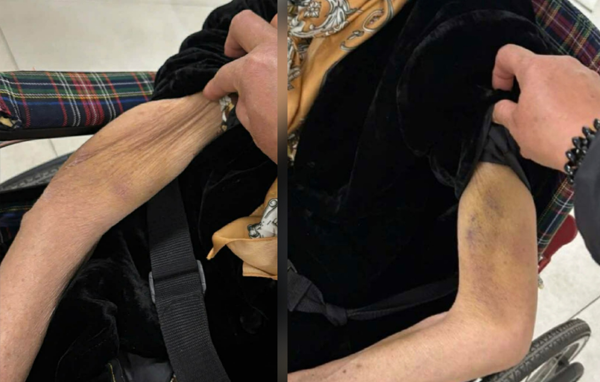 Tay cụ bà bị thâm tím nghi bị bạo hành - Ảnh: SKĐS