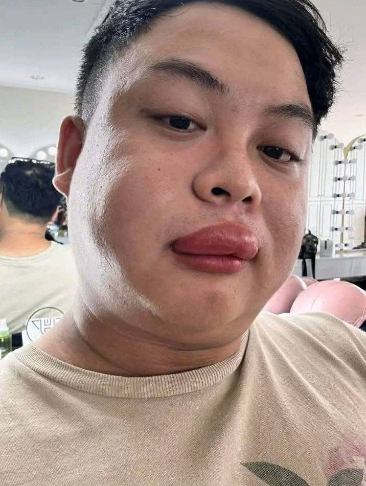 Khi ra về, anh Vân bị con ong đốt sưng môi. 