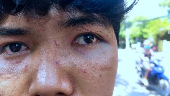 Gương mặt với những vết trầy xước của anh Luân - con trai bà Loan. (Ảnh: Thanh Niên)