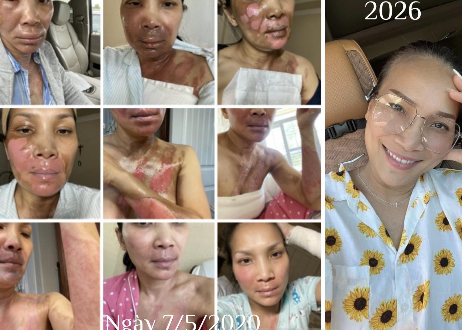 Hồng Ngọc công khai hình ảnh gương mặt bị bỏng nghiêm trọng vào năm 2020