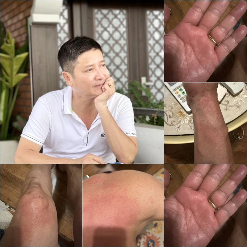 Chí Trung chia sẻ anh bị mắc bệnh lạ khiến cả người mẩn đỏ, ngứa ngáy, mặt mũi sưng phù