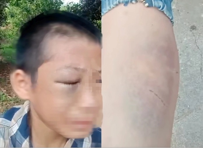 Hình ánh bé trai với nhiều vết bầm tím trên người gây xôn xao dư luận. (Ảnh cắt từ clip)