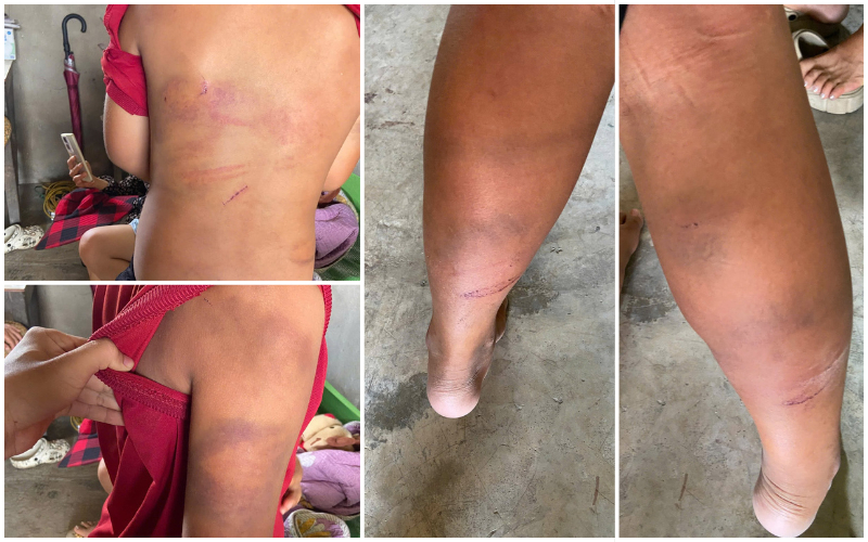 Các vết bầm tím trên cơ thể bé trai 11 tuổi