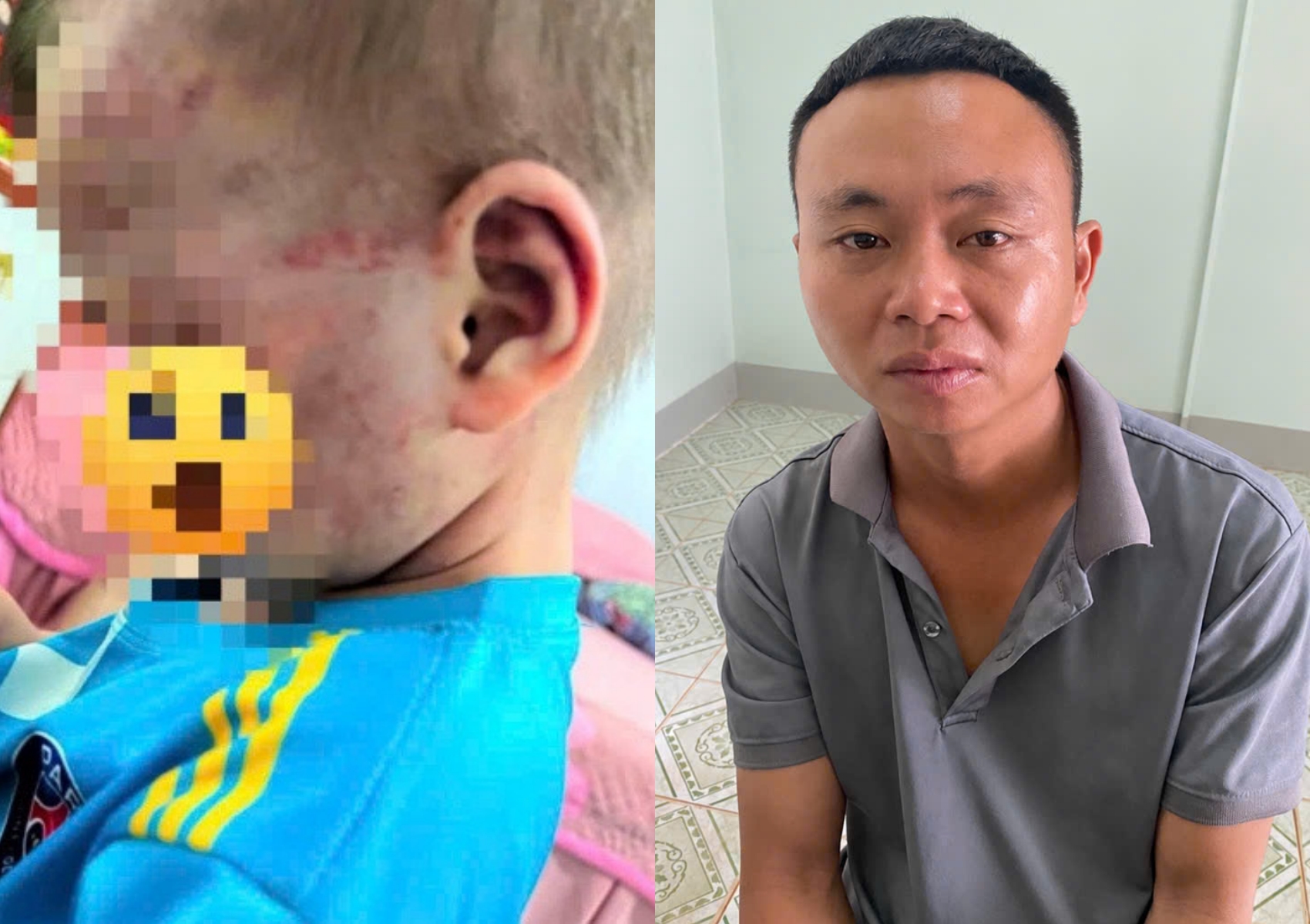 Vết thương của cháu bé 3 tuổi (bên trái) và bị can Nguyễn Hữu Nam