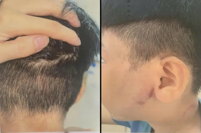 Cháu B. được xác định có nhiều vết bầm tím trên cơ thể sau khi bị đánh. (Nguồn: Báo SGGP)