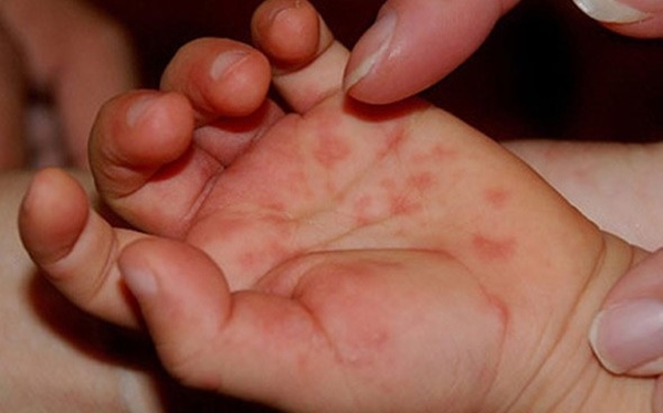 Virus cuối cùng đánh vào các vùng da ở tay, chân, miệng gây tổn thương da và niêm mạc.