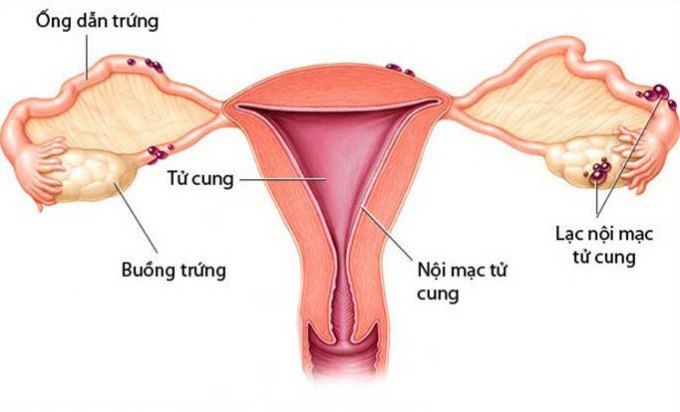Lạc nội mạc tử cung: lớp niêm mạc không nằm trong tử cung mà di chuyển đến chỗ khác.