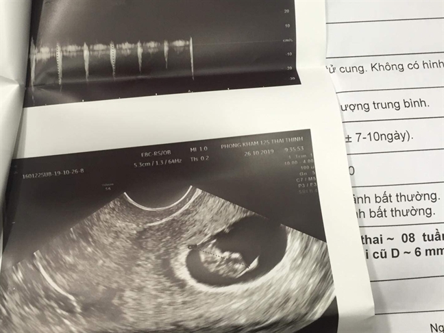 Kết quả siêu âm phát hiện có thai 8 tuần 2 ngày tuổi của chị N.A. tại Bệnh viện quốc tế Mỹ.