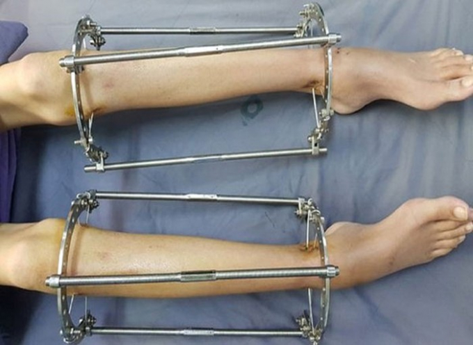 Phẫu thuật kéo chân chịu rất nhiều đau đớn và bất tiện trong thời gian chờ vết mổ hồi phục.
