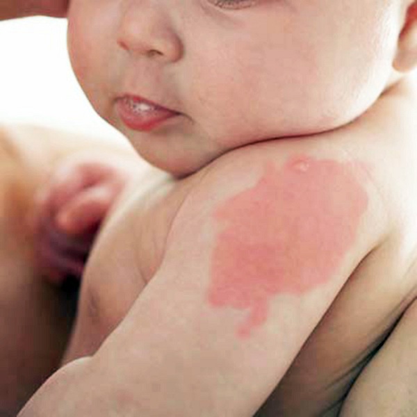Em bé có bớt đỏ trên người: Dấu hiệu cho thấy con sinh ra với một “vết son” đặc biệt