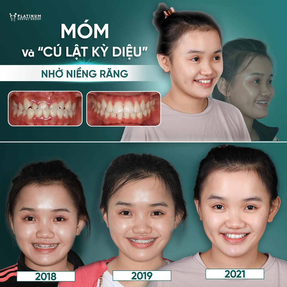 Một ca chỉnh nha tại Platinum Dental