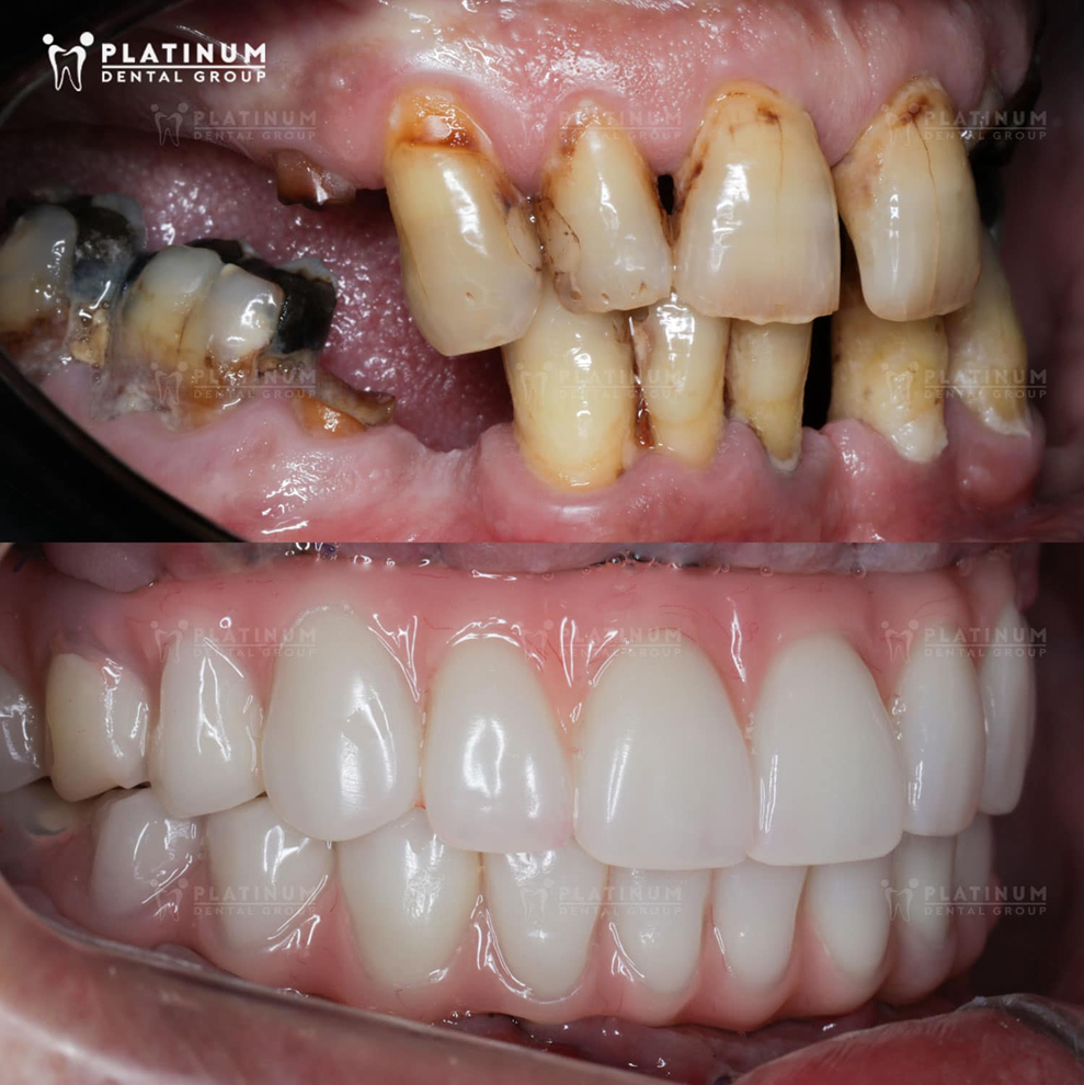 Cấy ghép Implant toàn hàm giúp phục hồi chức năng ăn nhai và thẩm mỹ nụ cười cho bệnh nhân đến từ Úc sau tình trạng răng tổn thương nghiêm trọng