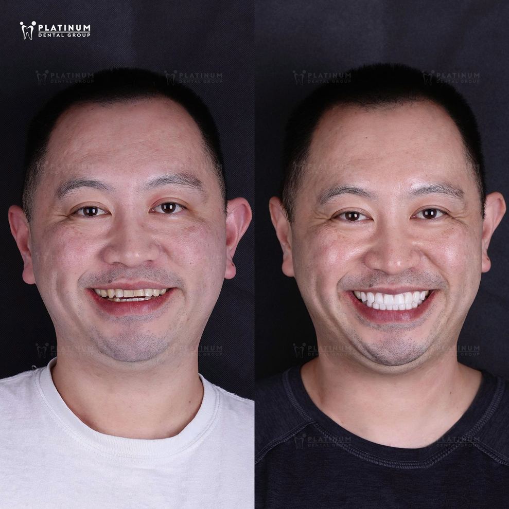 Dán sứ Veneer cá nhân hóa giúp cải thiện thẩm mỹ và khớp cắn cho khách hàng, chỉ sau 2 buổi điều trị tại Platinum Dental Group