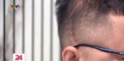 Hình ảnh vết thương trên đầu của một em học viên tại trung tâm. Ảnh: VTV1